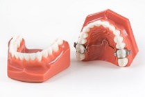 Uitdrukking overzee Literatuur De behandeling -Orthodontie Merwestein